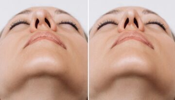 A close-up of woman's nose before and after rhinoplasty on gray background. The result of cosmetic plastic surgery on the nose. Bottom view. Correction of the nasal septum. Beauty concept