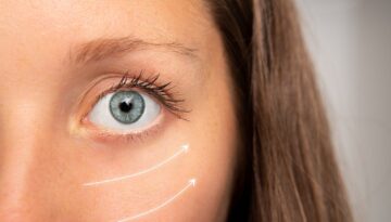 Blefaroplastyka dolnych powiek: skuteczny sposób na pozbycie się worków pod oczami